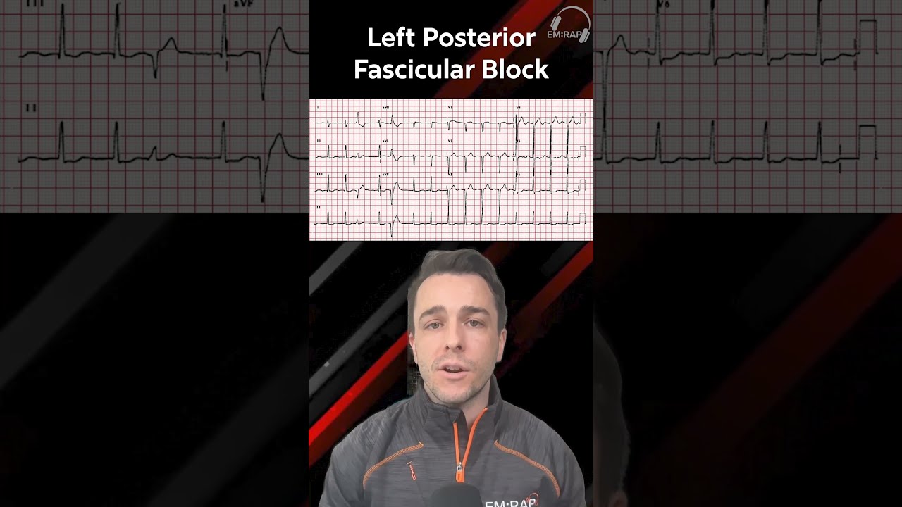 How To Spot A Fascicular Block On ECG