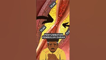 Alternatif Bedah Bypass Jantung Penyakit Jantung Kardiovaskular (CVD) #Shorts #cathlab #jantung