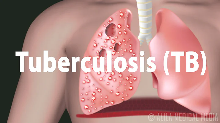 Tuberculosis (TB): Progression of the Disease, Latent and Active Infections. - DayDayNews