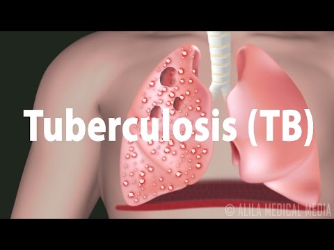 Video: Global Belastning Av Tuberkulose I Barndommen