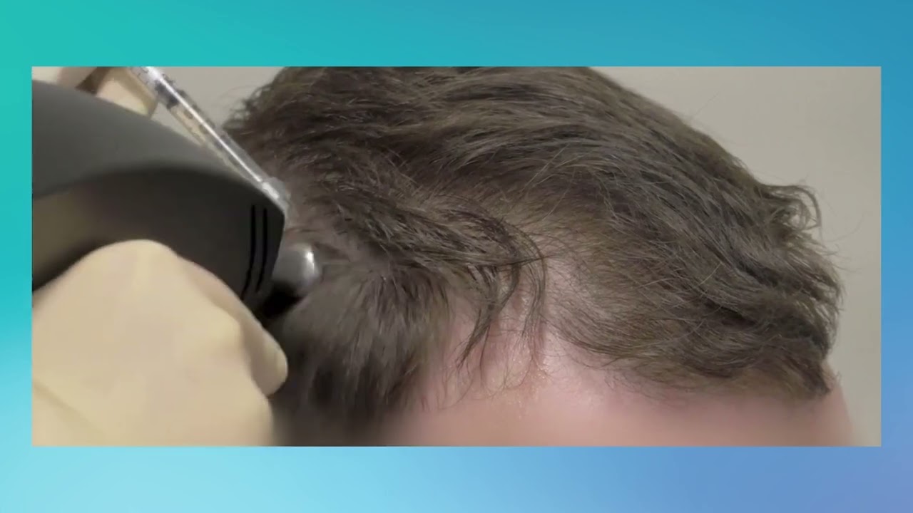 TED Hair Restoration YouTube TED Hair Restoration YouTube