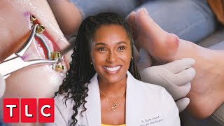 Dr. Ebonie Removes Massive Bunion and Fixes Foot Deformity | My Feet Are Killing Me