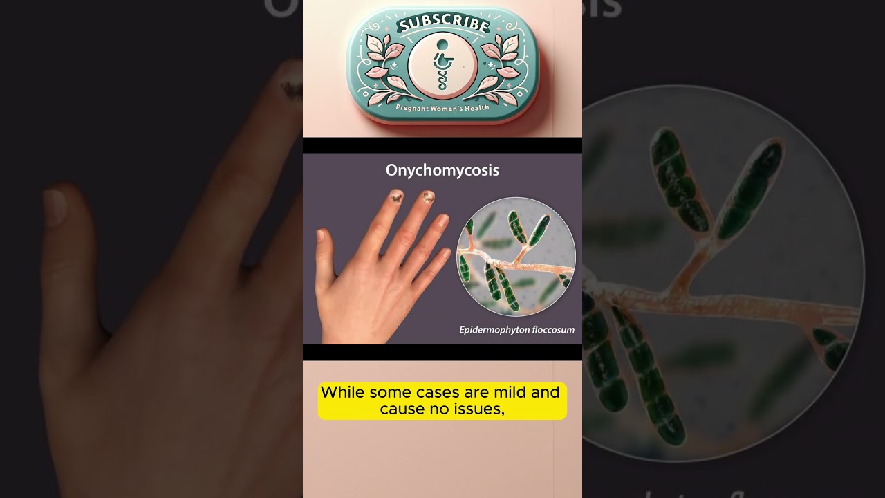 Understanding Polyhydramnios During Pregnancy 