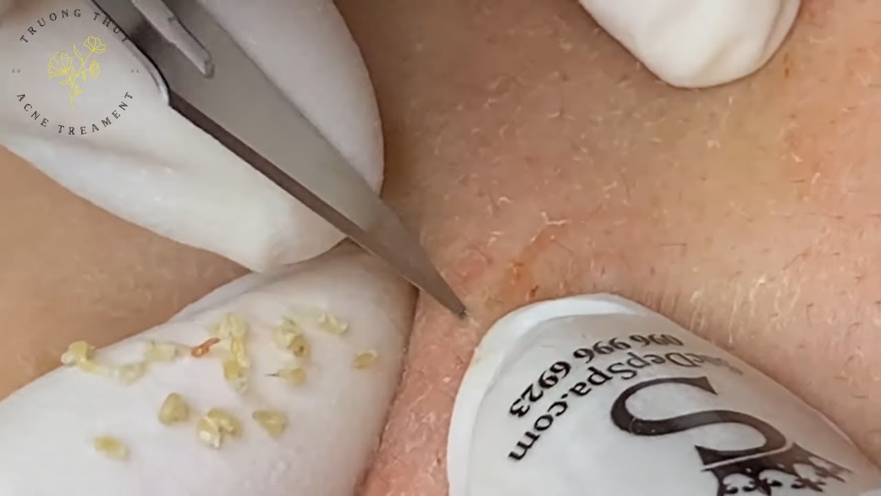 Acne Treament Under The Skin #024