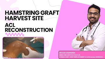 Hamstring Graft Harvest Site.. ACL Reconstruction..Dr Sai Chandra..Knee N Shoulder Surgeon in Hyd