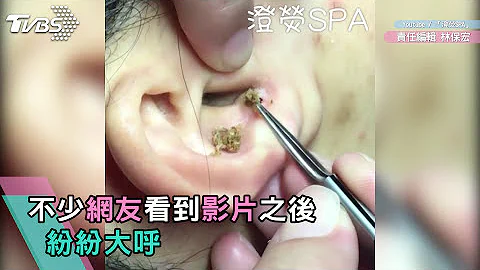 8分钟清完耳朵黑头粉刺　看完超疗愈 - 天天要闻