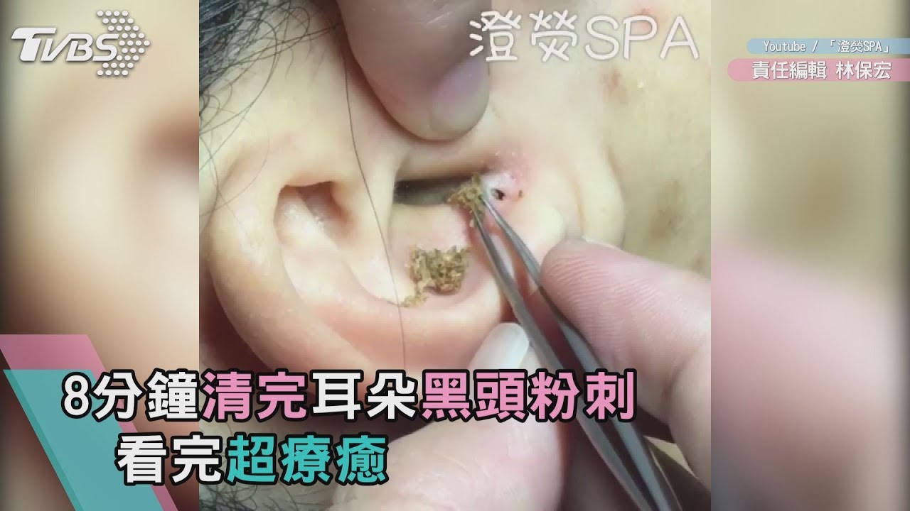 8分鐘清完耳朵黑頭粉刺看完超療癒 Youtube