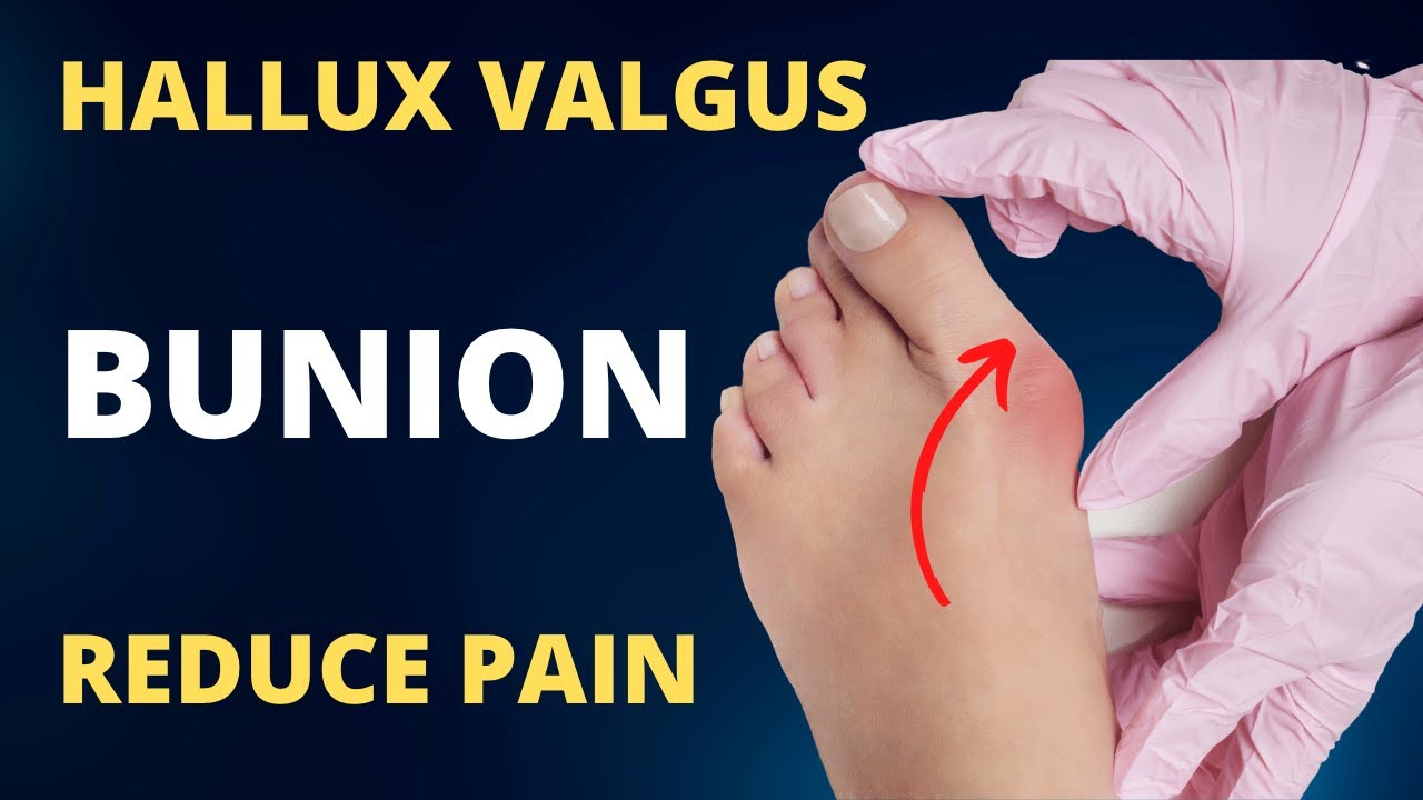 Foot and Ankle Problems By Dr. Richard Blake: Bunions: Tips on Conservative  Care