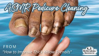 ASMR Pedicure Cleaning‍️How to Improve Thick Yellow Toenails