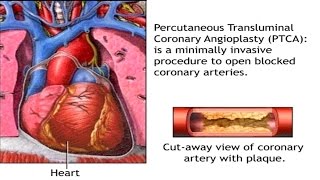 How Balloon Angioplasty is Done Animation - Coronary Angiography Procedure | Stenting in Heart Video screenshot 4