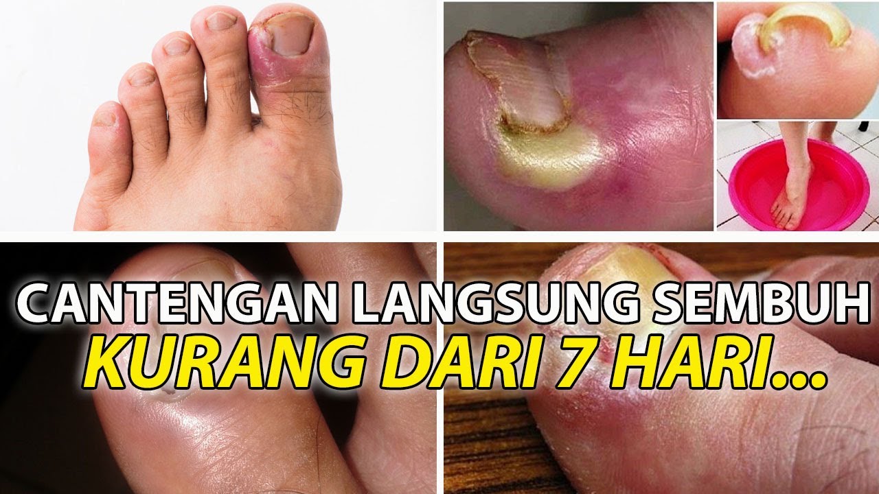 Cara Mengobati Cantengan AMPUH ! Cara Mengobati Cantengan - YouTube