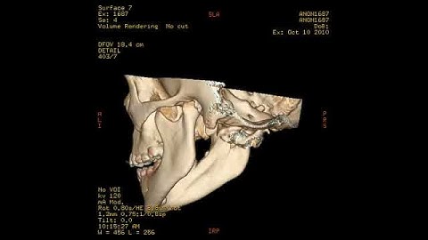 Mandible 3D Reconstruction 2.avi