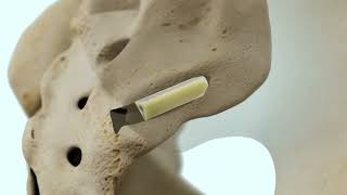 iFuse INTRA™ Allograft Implant System - Animation