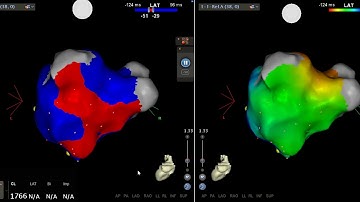 Left Atrial Roof Flutter Mapping using Carto® 3