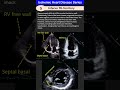 Ischemic Heart Disease 5: Inferior MI