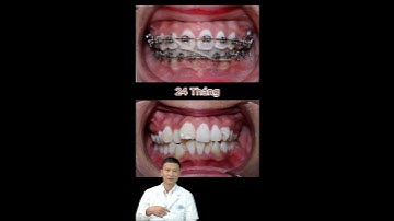 Răng Khấp Khểnh, Lệch Lạc? | Nha Khoa Minh Châu