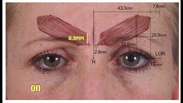 In-depth Guide To Treating The Glabella/Forehead With Botox | Dr Chris Hutton