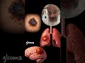 Tecnologia da vacina tratando o câncer!!  #curiosidades #ciência #saude