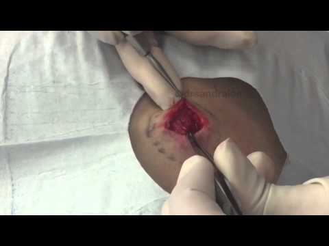 Warning, Some Graphic Content:  Standard Cyst Excision On The Back For Medical Education- NSFE.