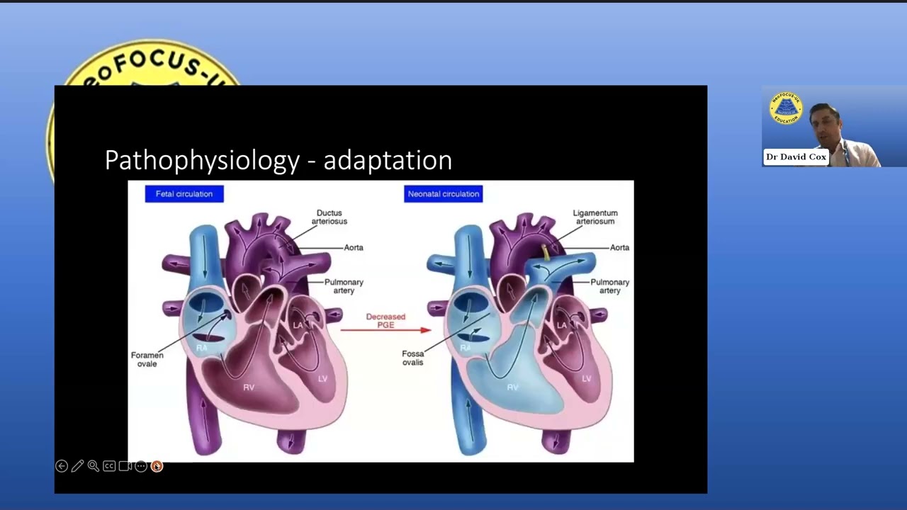 07.03.2025 Dr David Cox, Preterm cardiac remodelling, an unappreciated phenomenon?