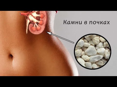 Камни симптомы