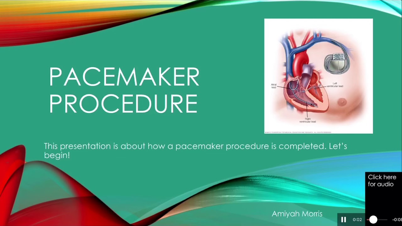 Pacemaker Oral Powerpoint Presentation YouTube