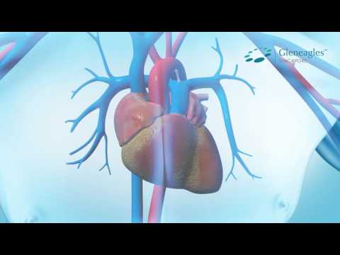 What You Need To Know About Coronary Artery Disease - Health Plus Animated