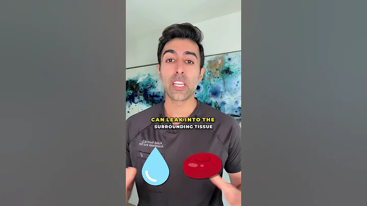 What Is Chronic Venous Insufficiency? President Trumps New Diagnosis