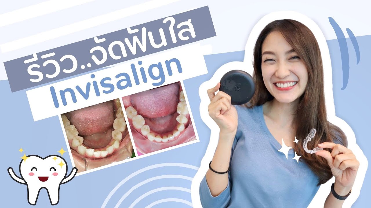 REVIEW จัดฟันใส Invisalign ราคาเกือบแสน! | Always AOM