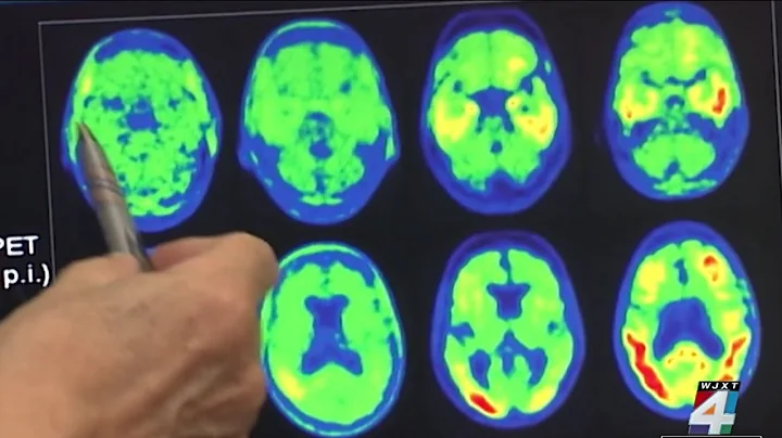 3 possible ways to slow down Alzheimer's disease