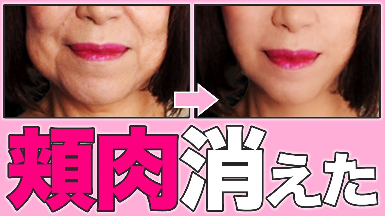 頬肉 たるみ 法令線が消える バッカルファット解消法 Youtube 頬肉 たるみ 法令線が消える バッカルファット解消法 Youtube
