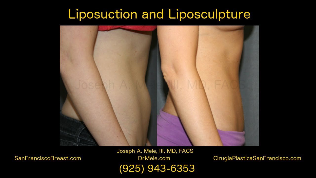 liposuction san francisco