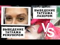 УДАЛЕНИЕ СТАРОГО ТАТУАЖА РЕМУВЕРОМ! Что лучше ремувер или лазер? Мой опыт!