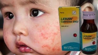 Informasi Obat Lerzin (Cetirizine sirup) Untuk mengatasi alergi kulit, rinitis #urticaria #rinitis