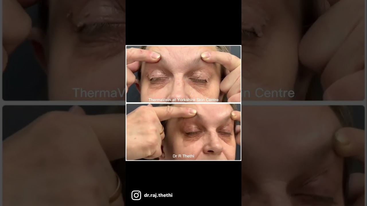 Removal of 45 skin tags on a patient’s eye lids using ThermaVein