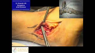     AITFL + CFL Repair with InternalBrace Augmentation | FiberTape SwiveLock Ankle Reconstruction