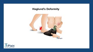 Haglund's Deformity