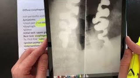 Diffuse Esophageal Spasm. USMLE review.