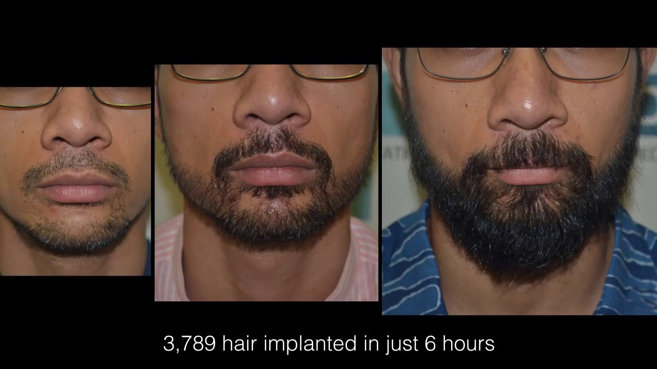 Beard Transplant - Beard Transplant Procedure, Results & Cost in India