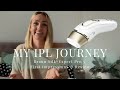 My At-Home IPL Journey | Braun Silk-Expert Pro 5 First Impressions & Honest Review | NON SPONSORED