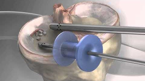 Partial Meniscectomy