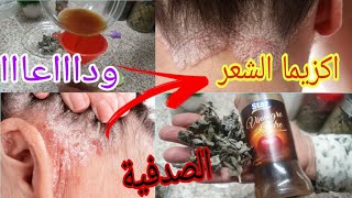 علاج الكزيما والصدفية /القشرة الشعر  في اي مكان في الجسم بمريوت وخل التفاح