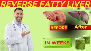 How to FIX Fatty Liver in Weeks,  Causes ,Symptoms and Treatments |Reverse Fatty liver naturally
