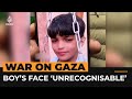 Injured Palestinian boy in Gaza no longer recognises his own face | Al Jazeera NewsFeed