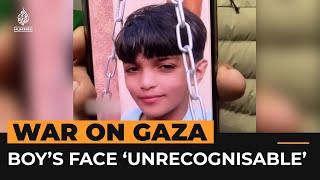 Injured Palestinian Boy In Gaza No Longer Recognises His Own Face Al Jazeera Newsfeed