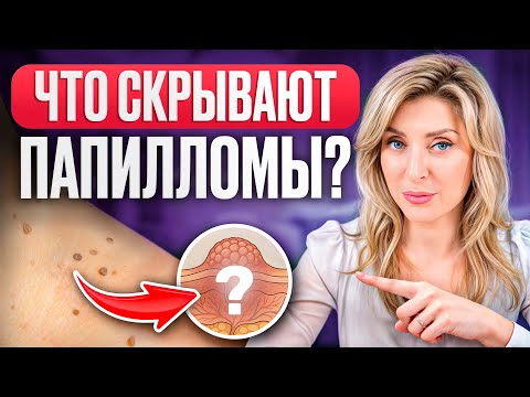 Удали сейчас, чтобы не допустить осложнений! / Как избавиться от папиллом и бородавок за ОДНУ ночь?