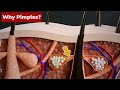 Why do we get PIMPLES? (3D Animation) #Shorts