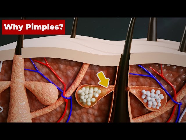 Why do we get PIMPLES? (3D Animation) #Shorts class=