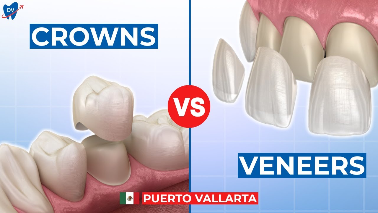 Difference Between Dental Crowns vs Veneers Explained by Top Mexico Dentists (Puerto Vallarta)