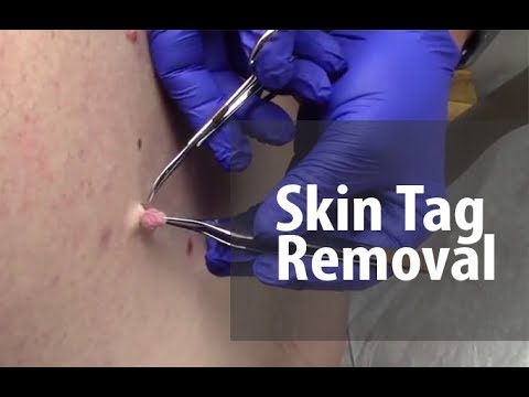 Video: Hoe u een huidtag kunt laten verwijderen door een arts: 14 stappen